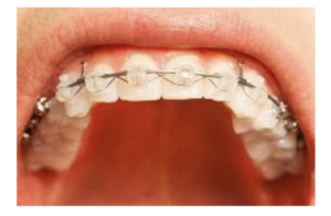 Best Dental Braces